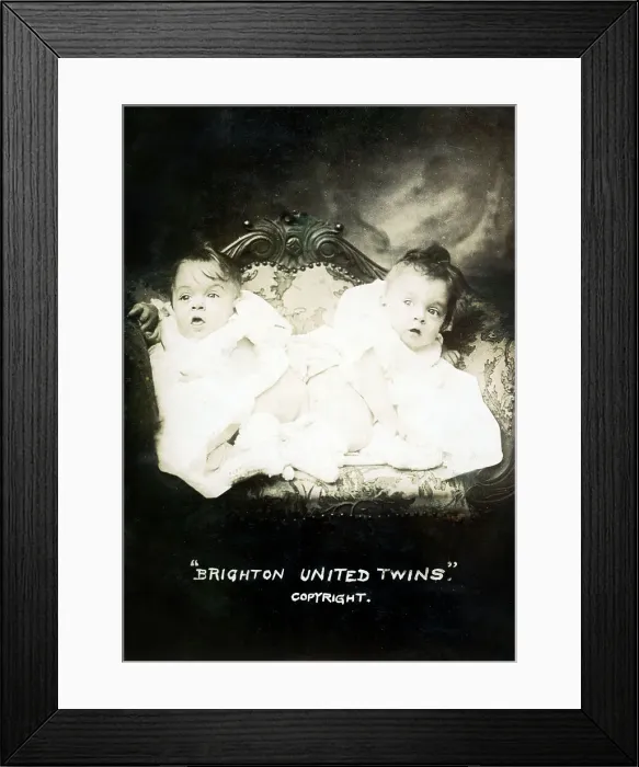 Framed Print : Famous conjoined sisters Daisy and Violet Hilton Framed Print : Famous conjoined sisters Daisy and Violet Hilton