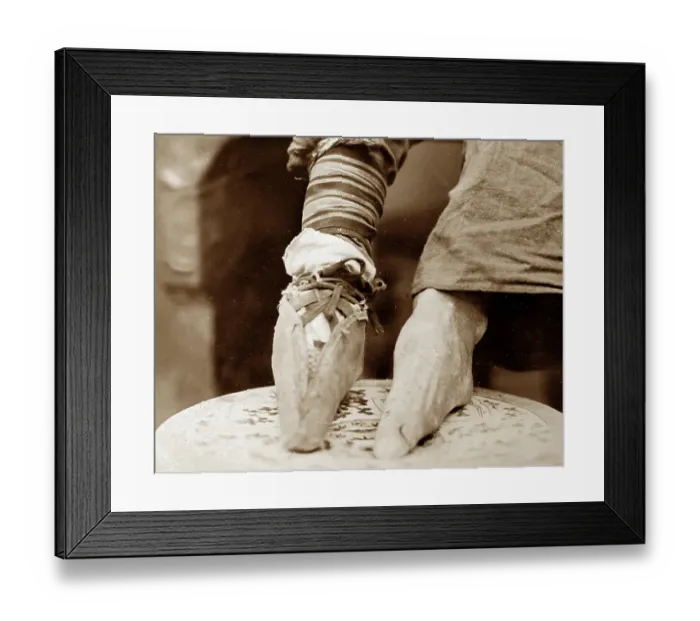 Framed Print : Bound feet, Chine, early 1900s Framed Print : Bound feet, Chine, early 1900s