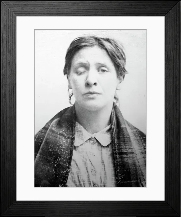 Framed Print : Symptom of Syphilis, 1920s projection slide Framed Print : Symptom of Syphilis, 1920s projection slide