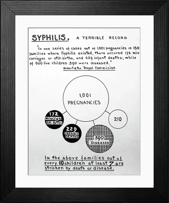 Framed Print : Syphilis and pregnancy, 1920s projection slide Framed Print : Syphilis and pregnancy, 1920s projection slide