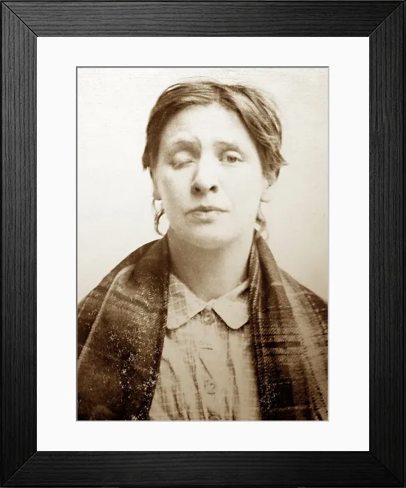 Framed Print : Symptom of Syphilis, 1920s projection slide Framed Print : Symptom of Syphilis, 1920s projection slide