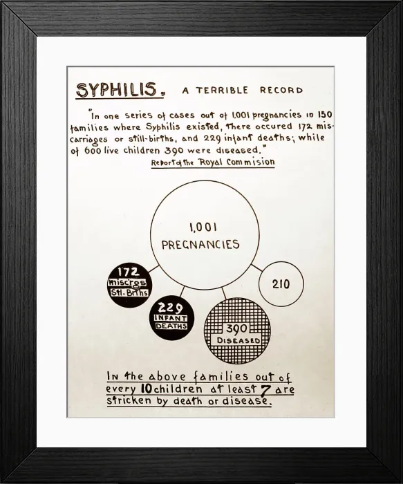 Framed Print : Syphilis and pregnancy, 1920s projection slide Framed Print : Syphilis and pregnancy, 1920s projection slide