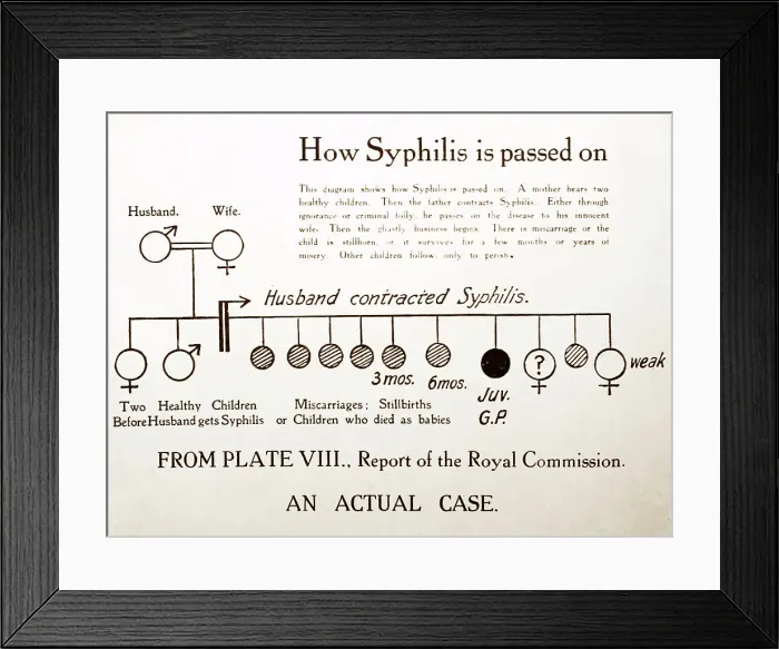 Framed Print : How syphilis is passed on, 1920s projection slide Framed Print : How syphilis is passed on, 1920s projection slide