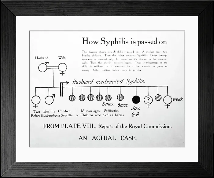 Framed Print : How syphilis is passed on, 1920s projection slide Framed Print : How syphilis is passed on, 1920s projection slide