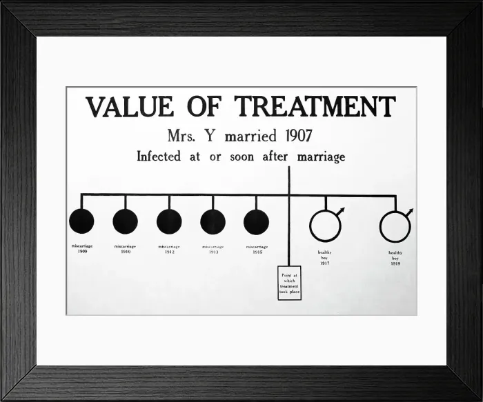 Framed Print : Syphilis treatment, 1920s projection slide Framed Print : Syphilis treatment, 1920s projection slide