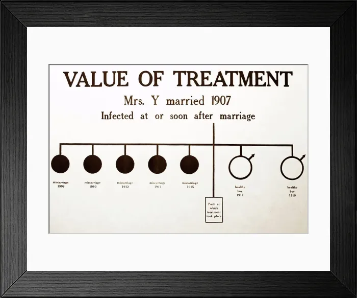 Framed Print : Syphilis treatment, 1920s projection slide Framed Print : Syphilis treatment, 1920s projection slide
