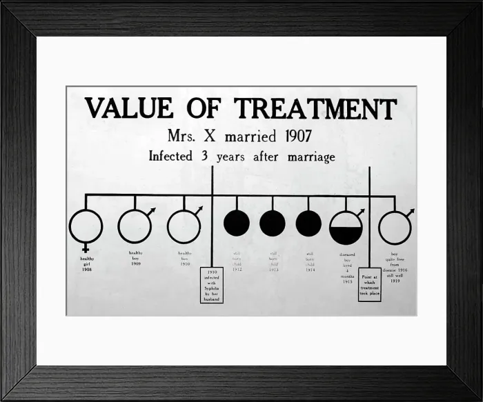 Framed Print : Syphilis treatment, 1920s projection slide Framed Print : Syphilis treatment, 1920s projection slide