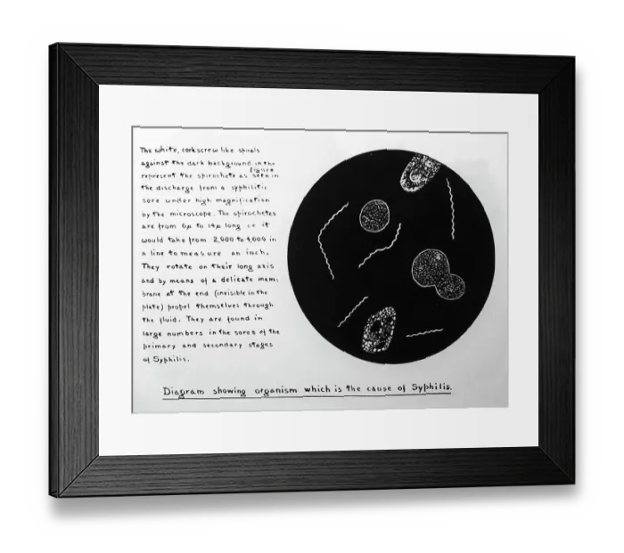Framed Print : The Syphilis organism, 1920s projection slide Framed Print : The Syphilis organism, 1920s projection slide