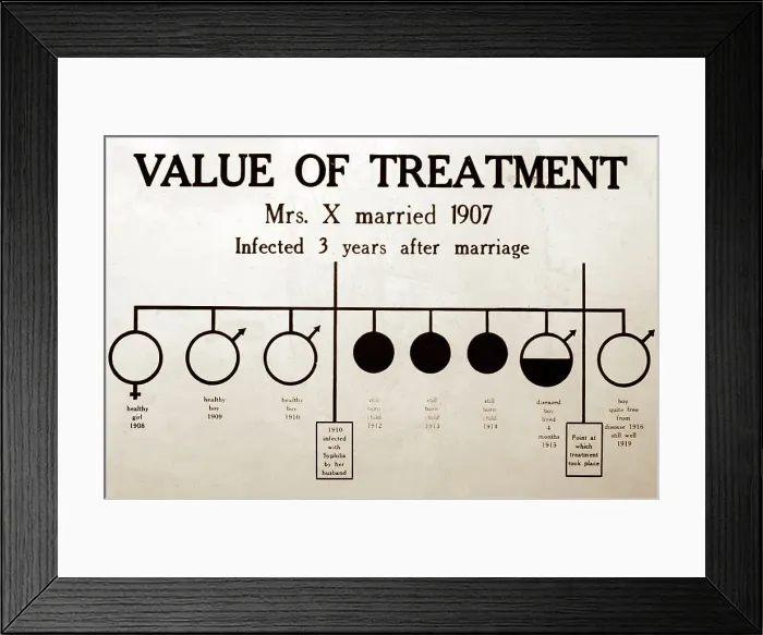 Framed Print : Syphilis treatment, 1920s projection slide Framed Print : Syphilis treatment, 1920s projection slide