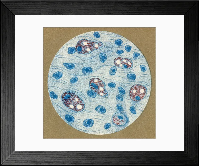 Framed Print : Bacillus of leprosy discovered by Hansen, 1877 Framed Print : Bacillus of leprosy discovered by Hansen, 1877