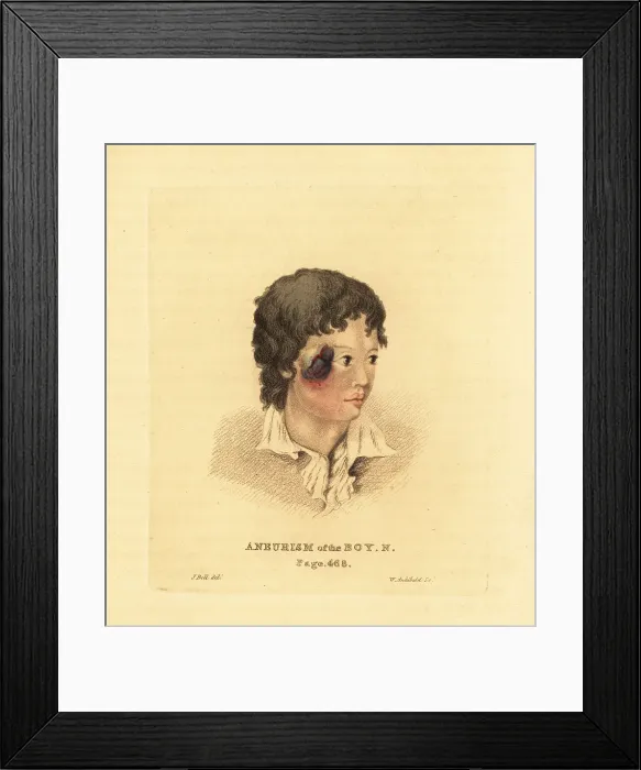 Framed Print : Aneurysmal tumor on the face of a young boy N, 1815 Framed Print : Aneurysmal tumor on the face of a young boy N, 1815