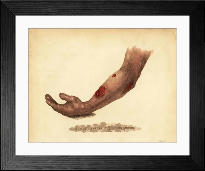 Framed Print : Abscess from a gunshot wound in the forearm, 1815 Framed Print : Abscess from a gunshot wound in the forearm, 1815