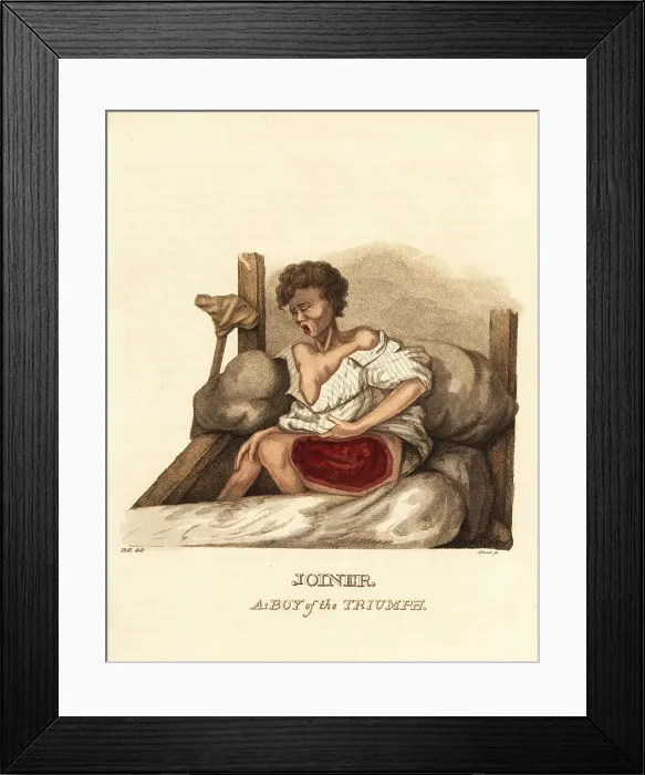 Framed Print : A ship's boy with a case of necrotizing fasciitis Framed Print : A ship's boy with a case of necrotizing fasciitis