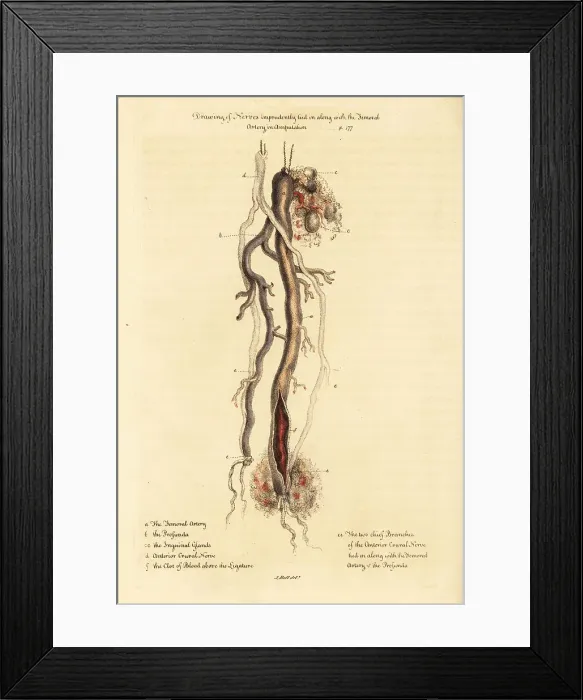 Framed Print : Claude Pouteau's doctrine of tying nerves to arteries in amputat Framed Print : Claude Pouteau's doctrine of tying nerves to arteries in amputat