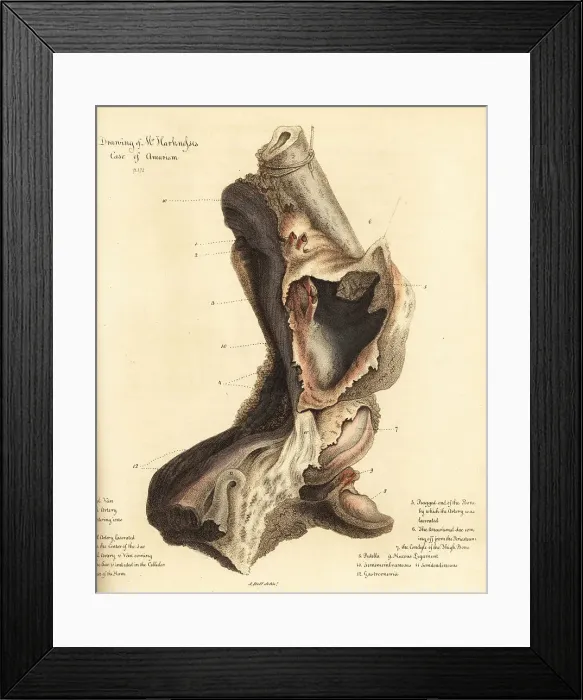 Framed Print : Fatal aneurysmal sac from the broken leg of a man, 1815 Framed Print : Fatal aneurysmal sac from the broken leg of a man, 1815