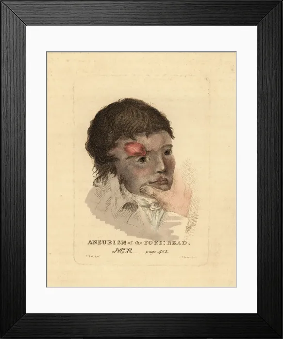 Framed Print : Aneurysmal tumor on the forehead of a young man, 1815 Framed Print : Aneurysmal tumor on the forehead of a young man, 1815