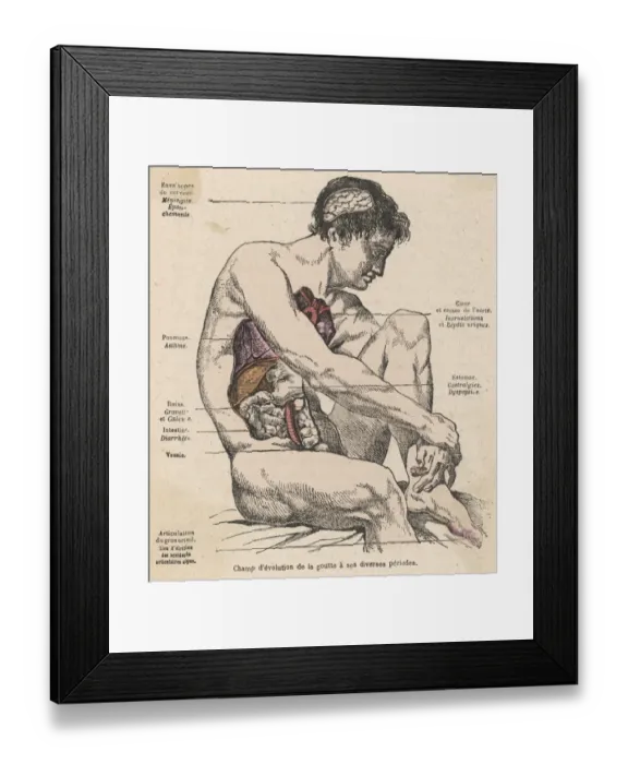 Framed Print : GOUT. Diagram to show how various parts of the body are affected by the Framed Print : GOUT. Diagram to show how various parts of the body are affected by the