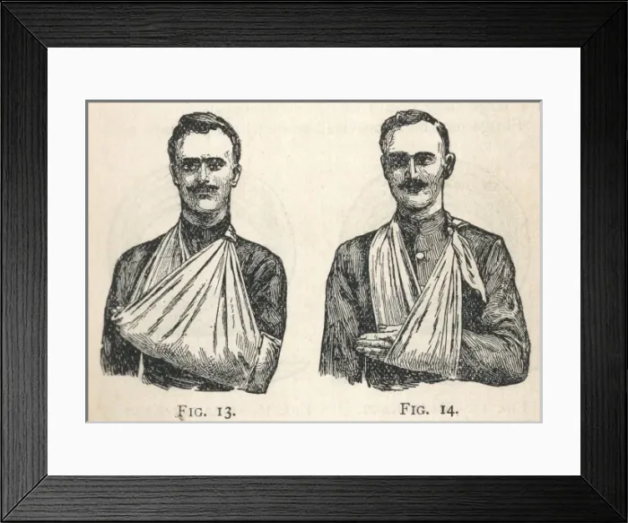 Framed Print : Illustrations of large and small arm slings Framed Print : Illustrations of large and small arm slings