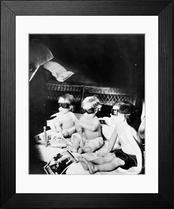 Framed Print : Children being treated with ultra-violet light Framed Print : Children being treated with ultra-violet light