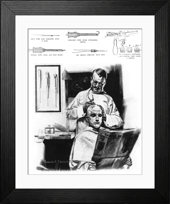 Framed Print : Hair transplant Framed Print : Hair transplant