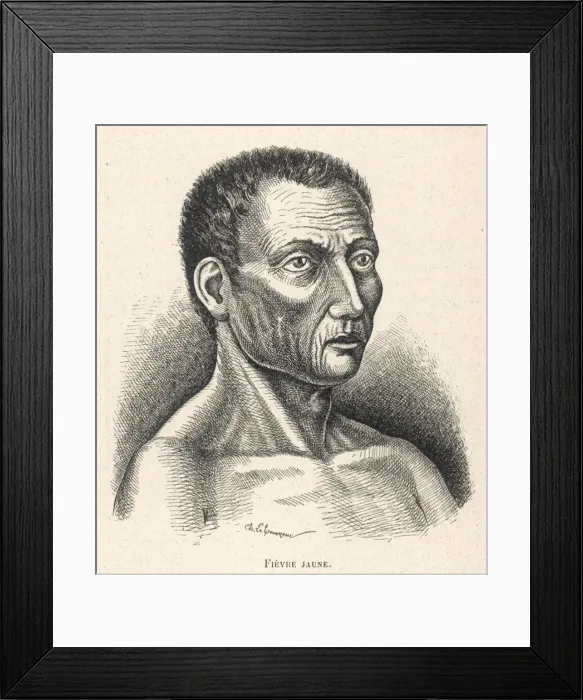 Framed Print : Yellow Fever Victim Framed Print : Yellow Fever Victim