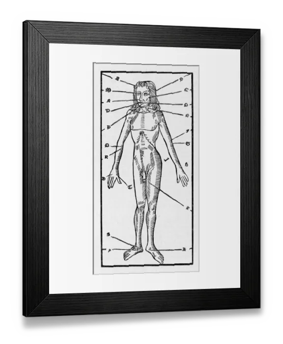 Framed Print : Phlebotomy of the Body Framed Print : Phlebotomy of the Body