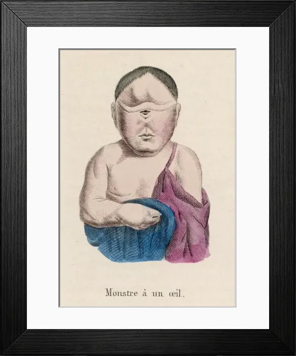 Framed Print : Child with One Eye Framed Print : Child with One Eye