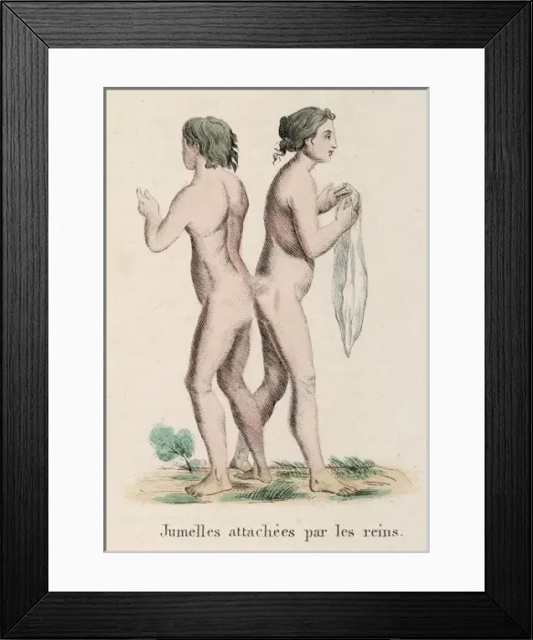Framed Print : Attached Twins Framed Print : Attached Twins