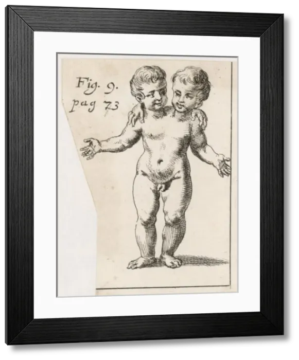 Framed Print : Two-Headed Child / 1691 Framed Print : Two-Headed Child / 1691