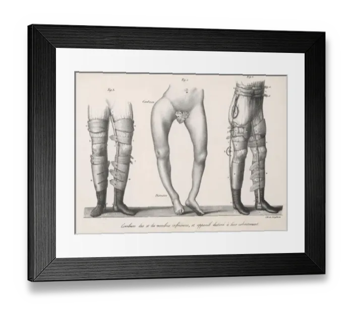 Framed Print : Treating Bow Legs (2) Framed Print : Treating Bow Legs (2)