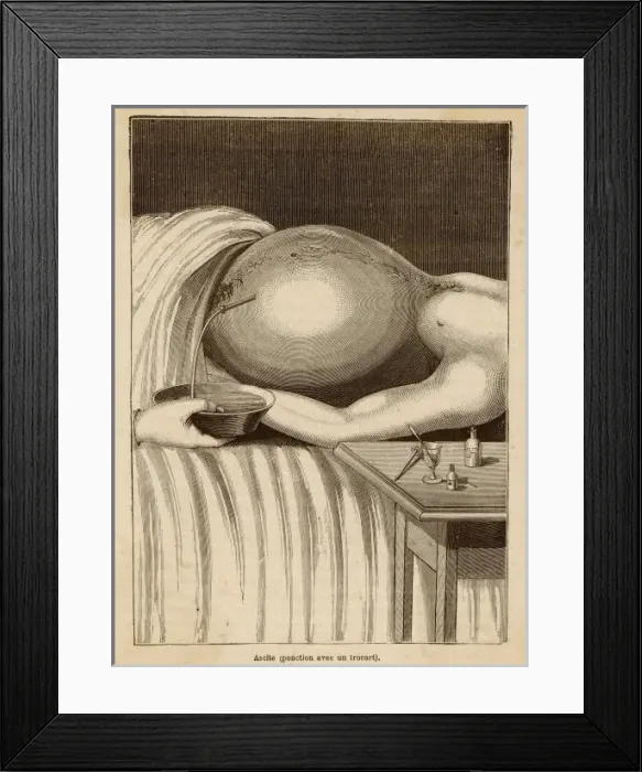 Framed Print : Removal of Fluid Framed Print : Removal of Fluid