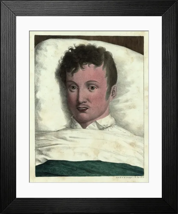 Framed Print : The early stages of yellow fever Framed Print : The early stages of yellow fever