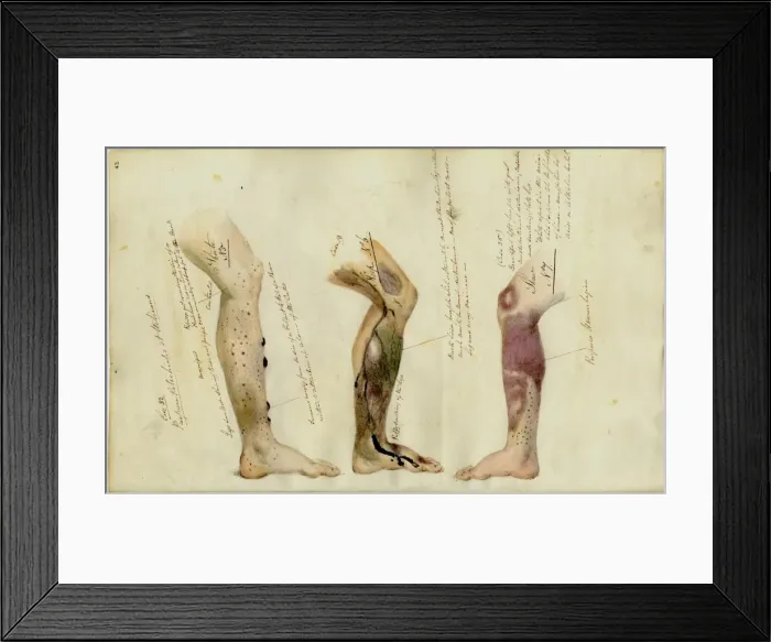 Framed Print : Effects of Scurvy Framed Print : Effects of Scurvy