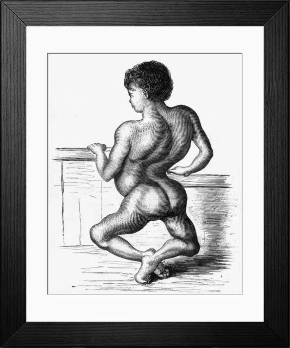 Framed Print : Medical / Ailments / Rickets Framed Print : Medical / Ailments / Rickets
