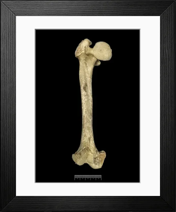 Framed Print : Femur of Achondroplastic Dwarf Framed Print : Femur of Achondroplastic Dwarf