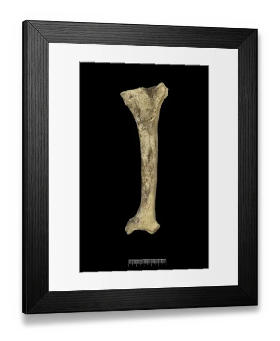 Framed Print : Humerus of Achondroplastic Dwarf Framed Print : Humerus of Achondroplastic Dwarf