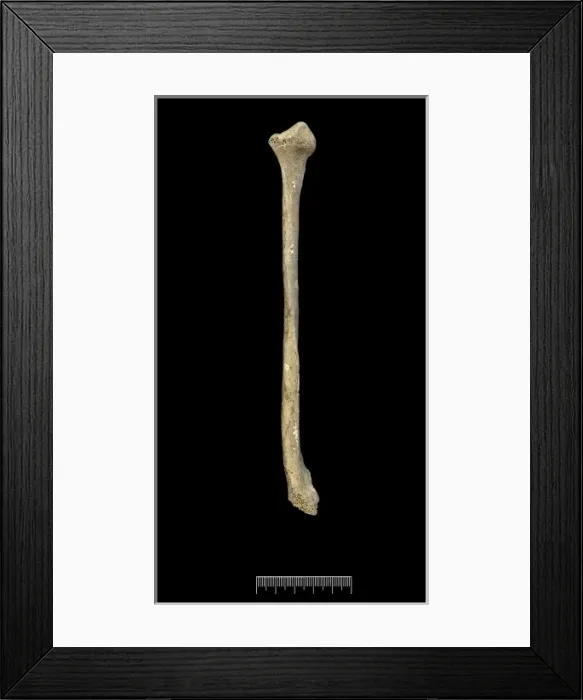 Framed Print : Fibula of Achondroplastic Dwarf Framed Print : Fibula of Achondroplastic Dwarf