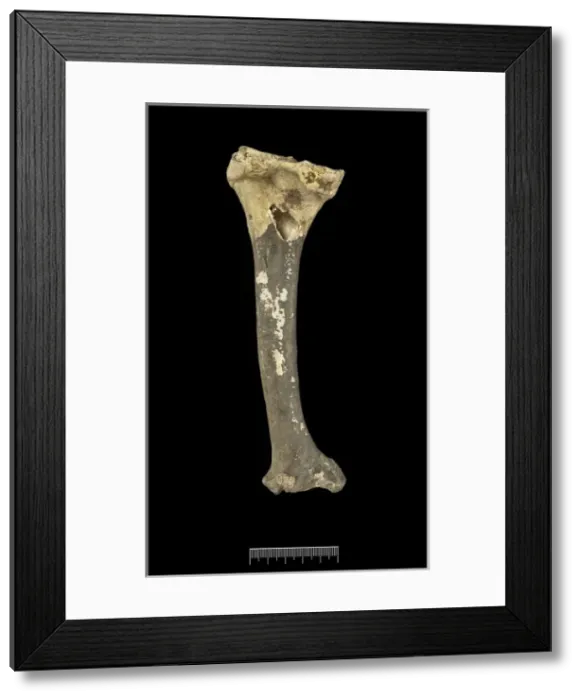 Framed Print : Humerus of Achondroplastic Dwarf Framed Print : Humerus of Achondroplastic Dwarf