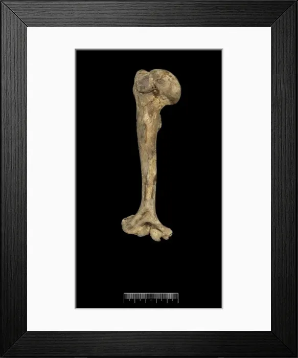 Framed Print : Humerus of Achondroplastic Dwarf Framed Print : Humerus of Achondroplastic Dwarf