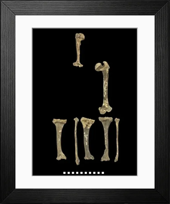 Framed Print : Bones of Achondroplastic Dwarf Framed Print : Bones of Achondroplastic Dwarf