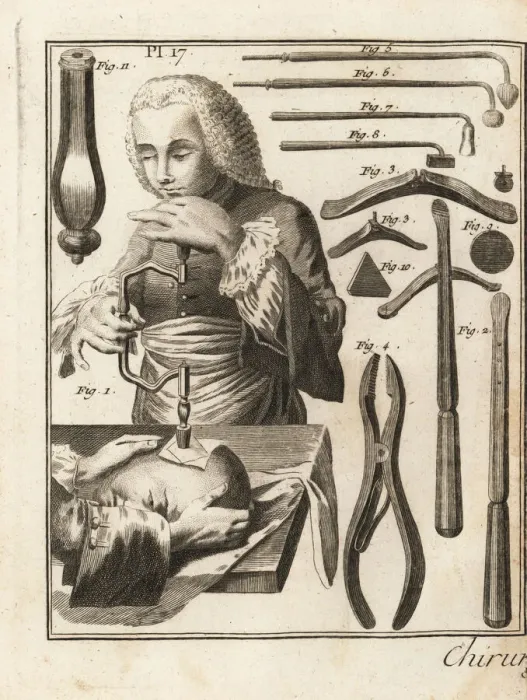 Framed Print : 18th century surgeon performing a trepanning Framed Print : 18th century surgeon performing a trepanning
