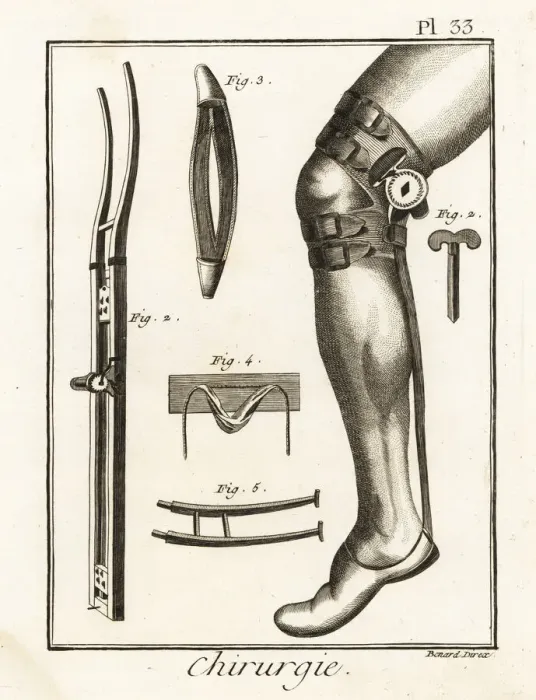 Framed Print : 18th century surgical knee pad and dislocation machine Framed Print : 18th century surgical knee pad and dislocation machine