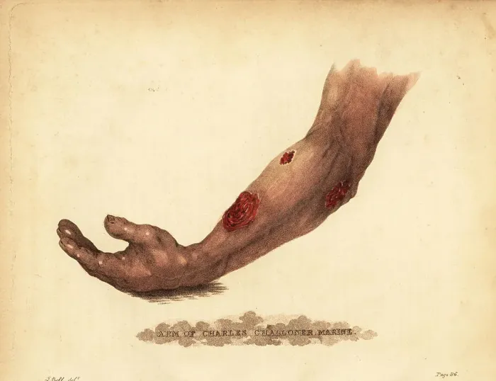 Framed Print : Abscess from a gunshot wound in the forearm, 1815 Framed Print : Abscess from a gunshot wound in the forearm, 1815