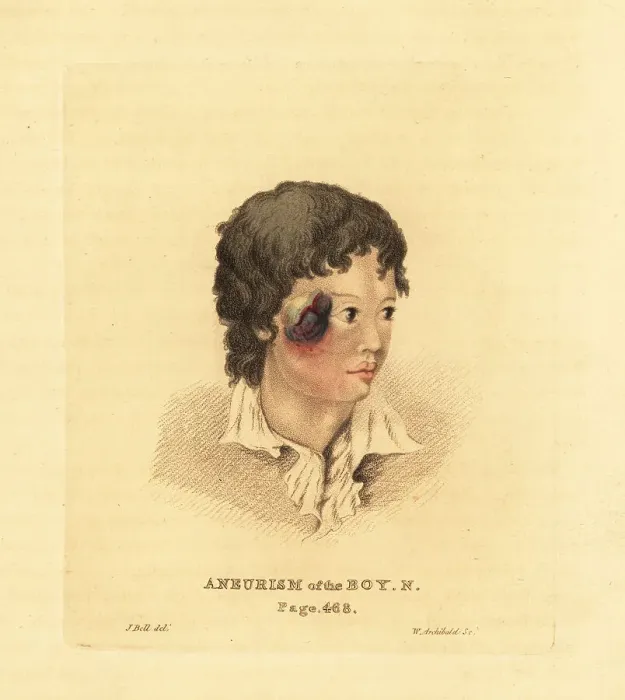 Framed Print : Aneurysmal tumor on the face of a young boy N, 1815 Framed Print : Aneurysmal tumor on the face of a young boy N, 1815