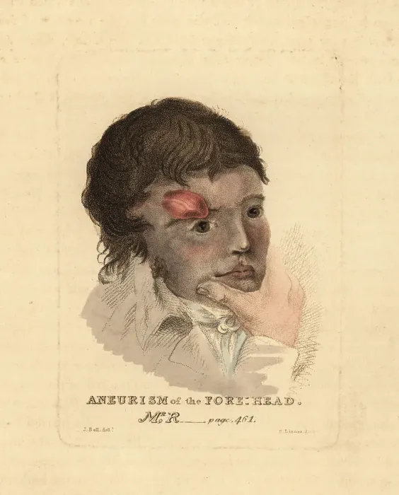 Framed Print : Aneurysmal tumor on the forehead of a young man, 1815 Framed Print : Aneurysmal tumor on the forehead of a young man, 1815