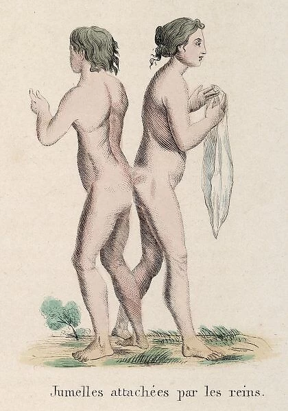 Attached Twins. Two females born attached by their buttocks