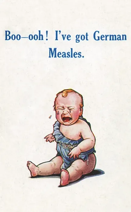 Framed Print : Baby with German Measles - WWI connection Framed Print : Baby with German Measles - WWI connection