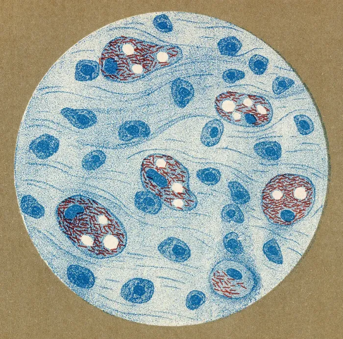 Framed Print : Bacillus of leprosy discovered by Hansen, 1877 Framed Print : Bacillus of leprosy discovered by Hansen, 1877