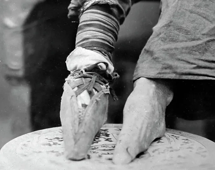 Framed Print : Bound feet, China, early 1900s Framed Print : Bound feet, China, early 1900s