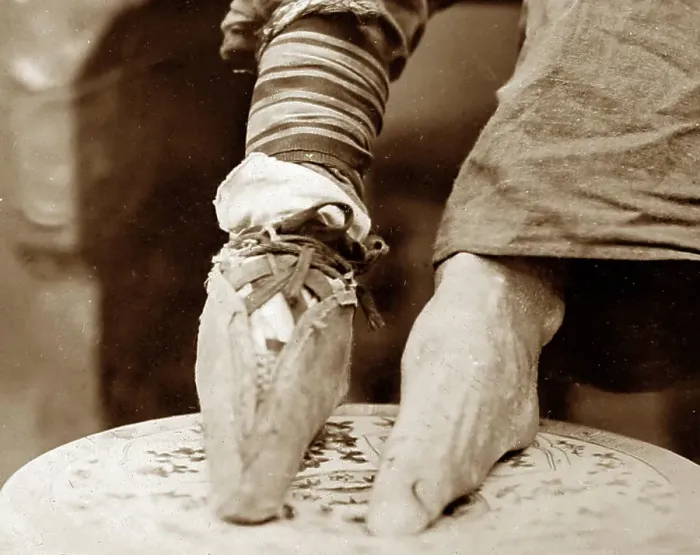 Framed Print : Bound feet, Chine, early 1900s Framed Print : Bound feet, Chine, early 1900s